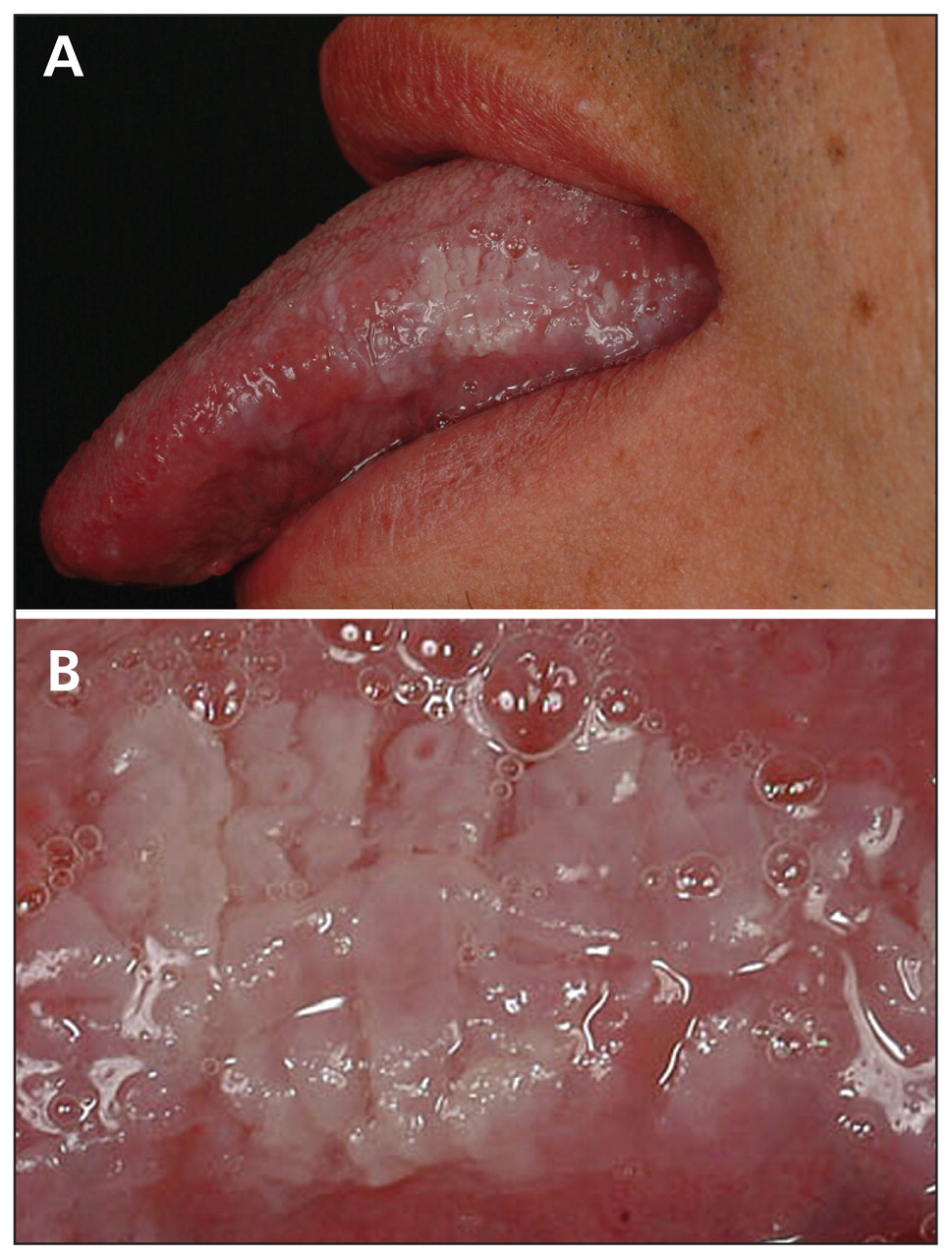 Oral hairy leukoplakia: a clinical indicator of ...