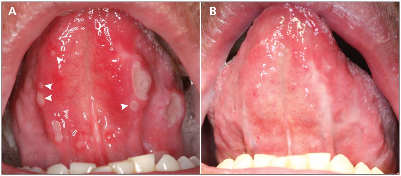 aphthous ulcers