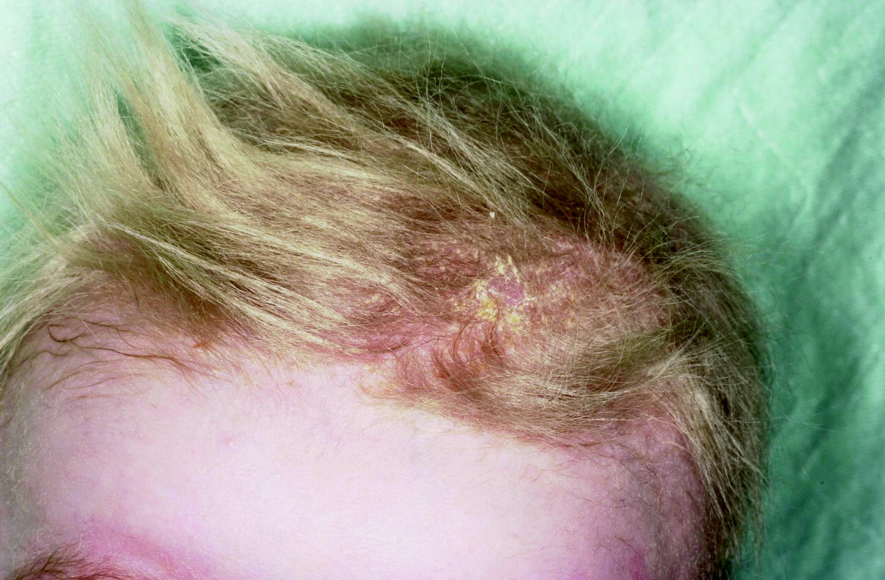 Children with Menkes disease Note the sparse hypopigmented hair and   Download Scientific Diagram