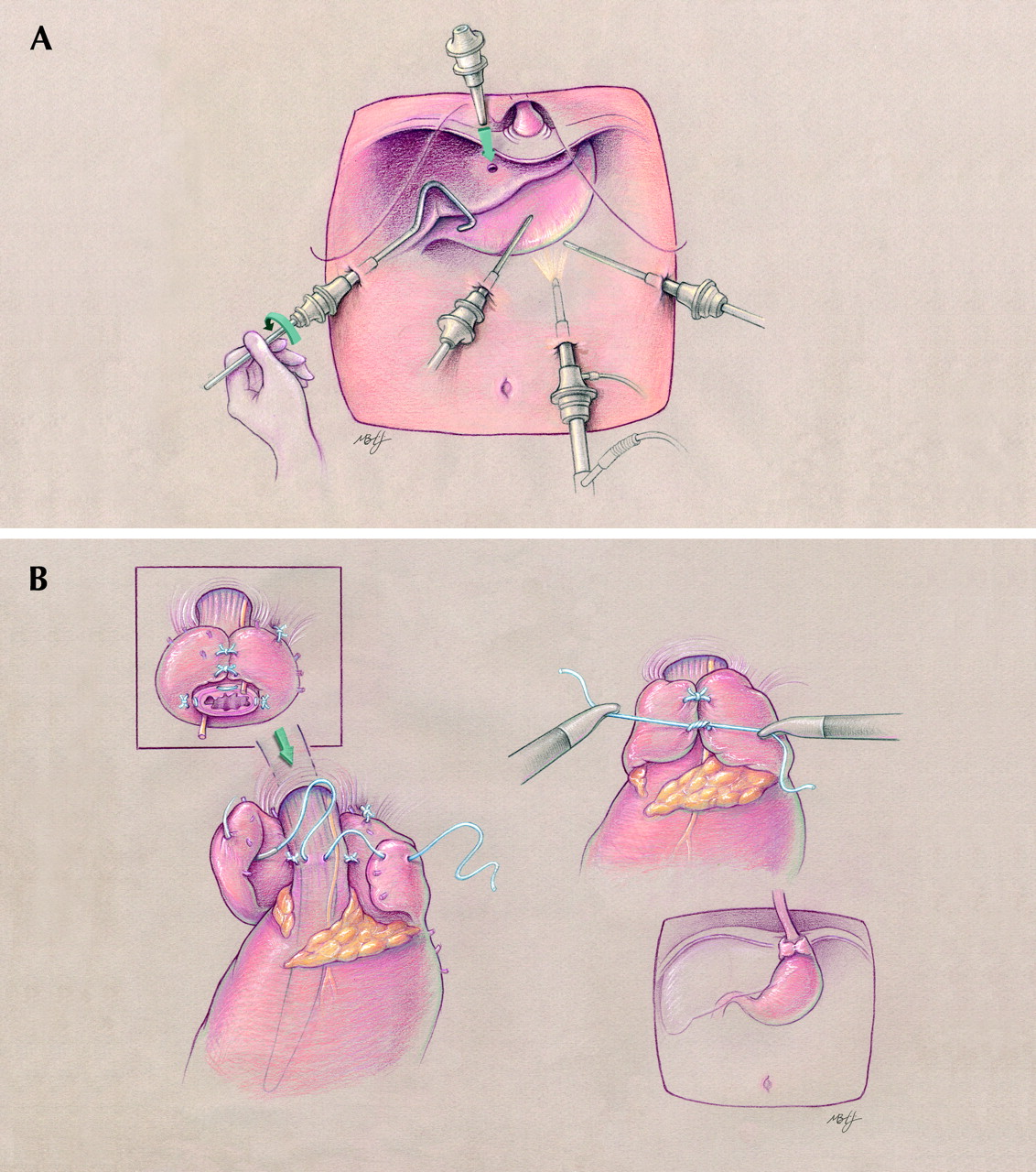 Whither surgery in the treatment of gastroesophageal reflux