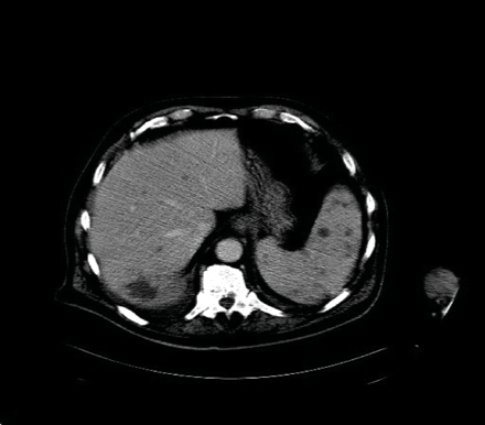 An elderly man with fever and hypodense lesions in the spleen and liver ...