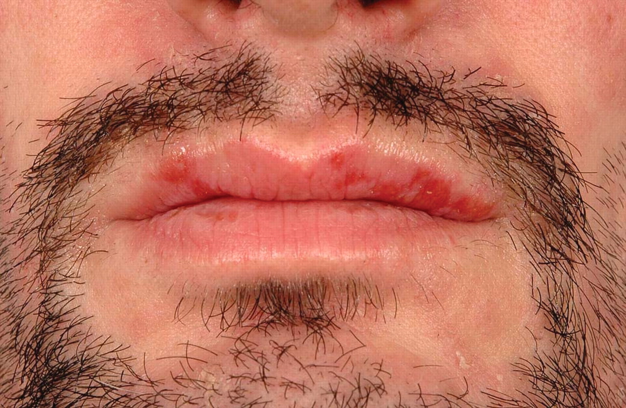 Syphilis Rash On Lips | Lipstutorial.org