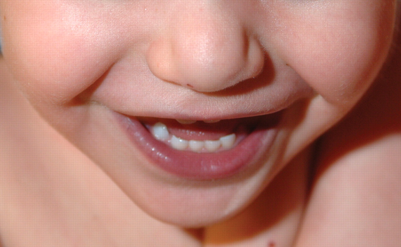 Почему синеет носогубный треугольник. Синюшность носогубного треугольника у ребенка. Синий носогубный треугольник у ребенка. Синяя носогубка у грудничка. Синюшность вокруг рта у ребенка.