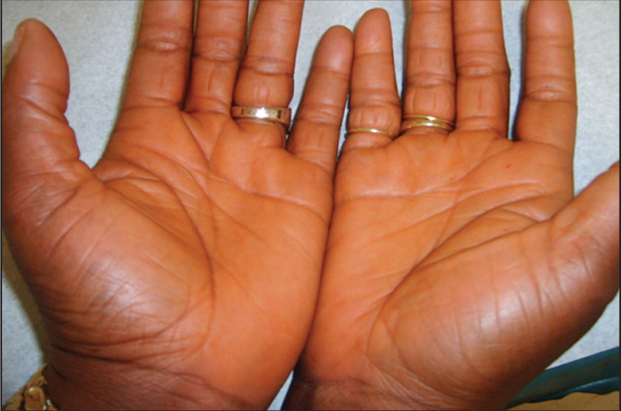 A dark lesion on the finger - Clinical Advisor