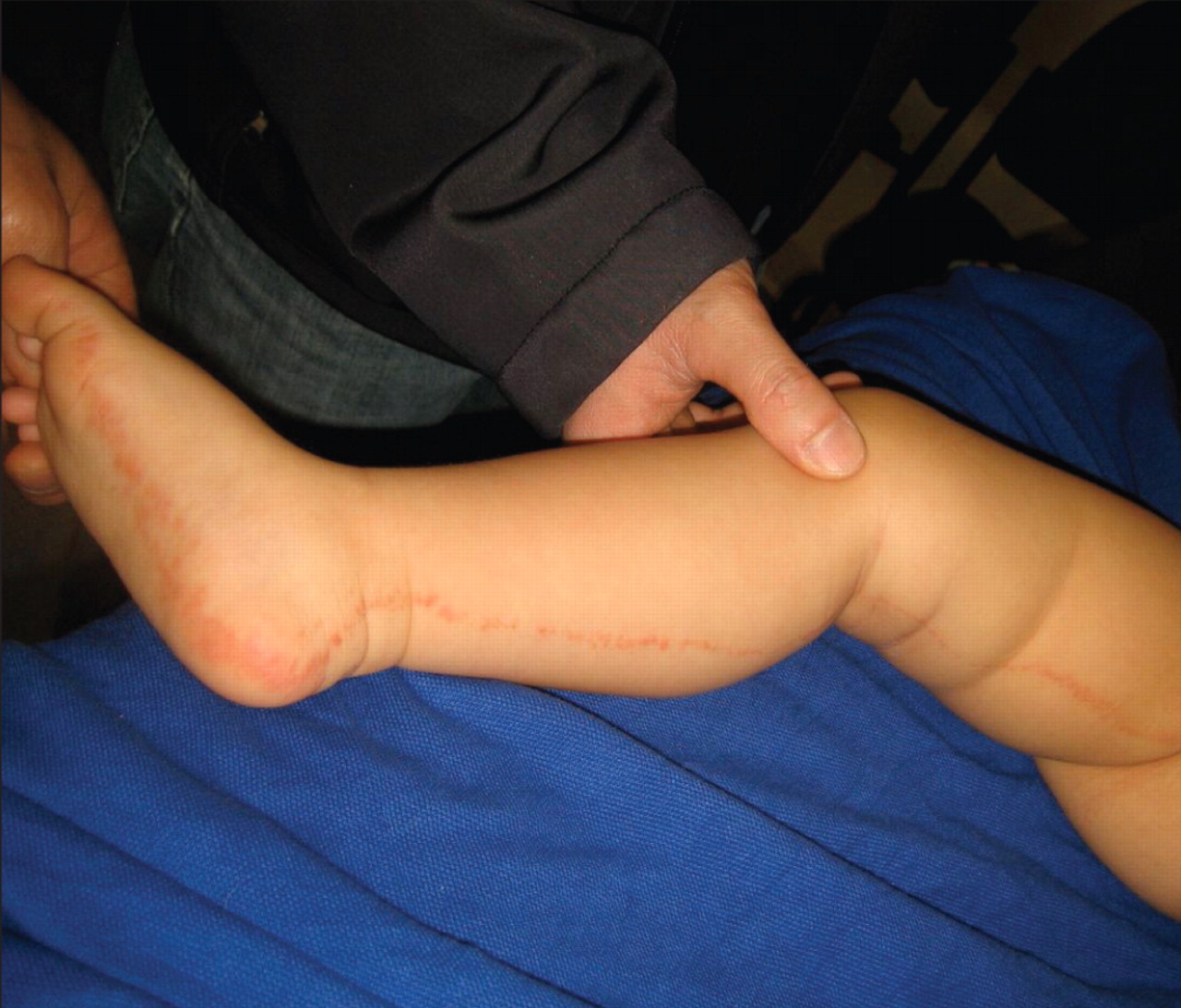 The toddler with 1 striped leg: a linear papular rash