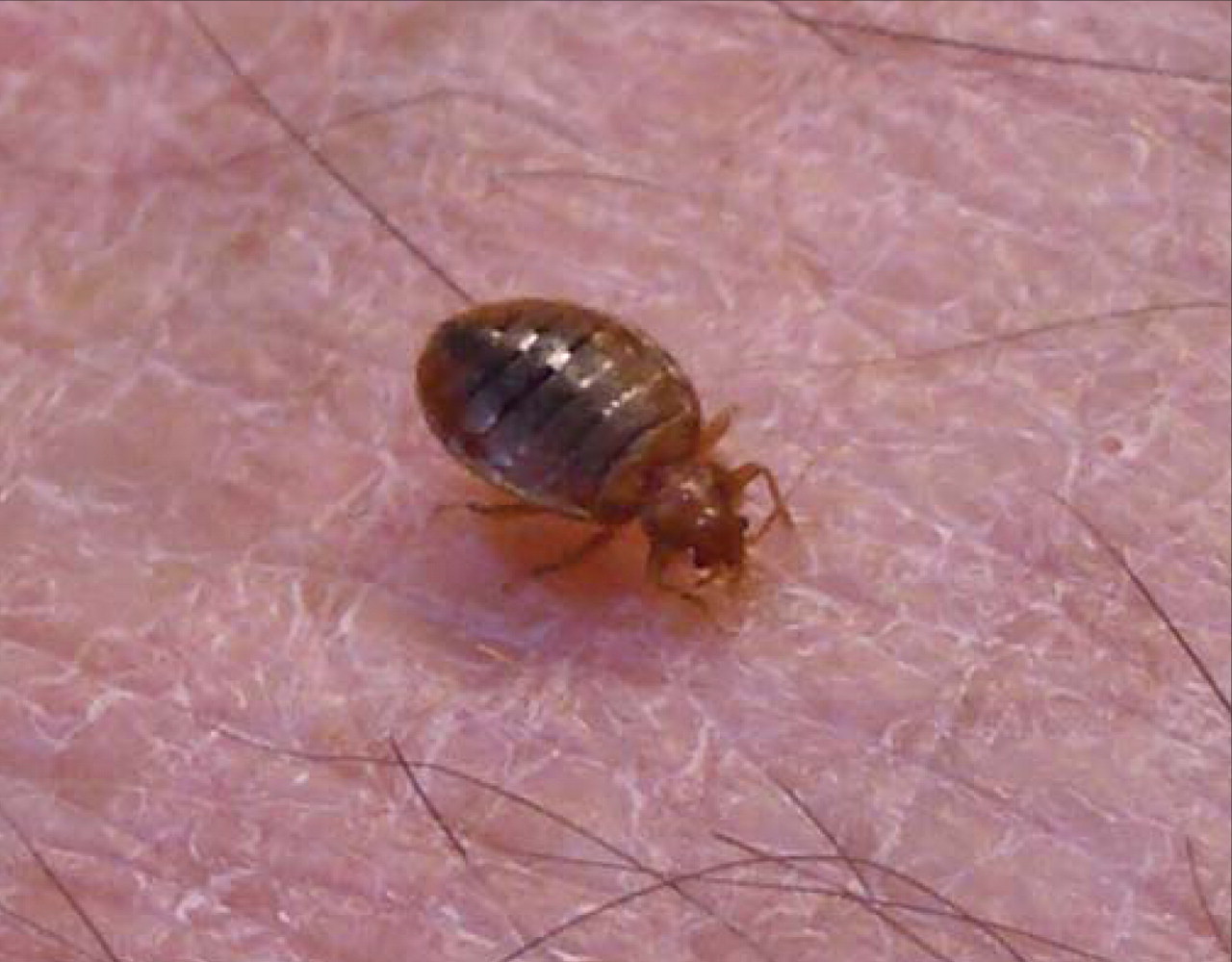 Severe anemia from bedbugs | CMAJ