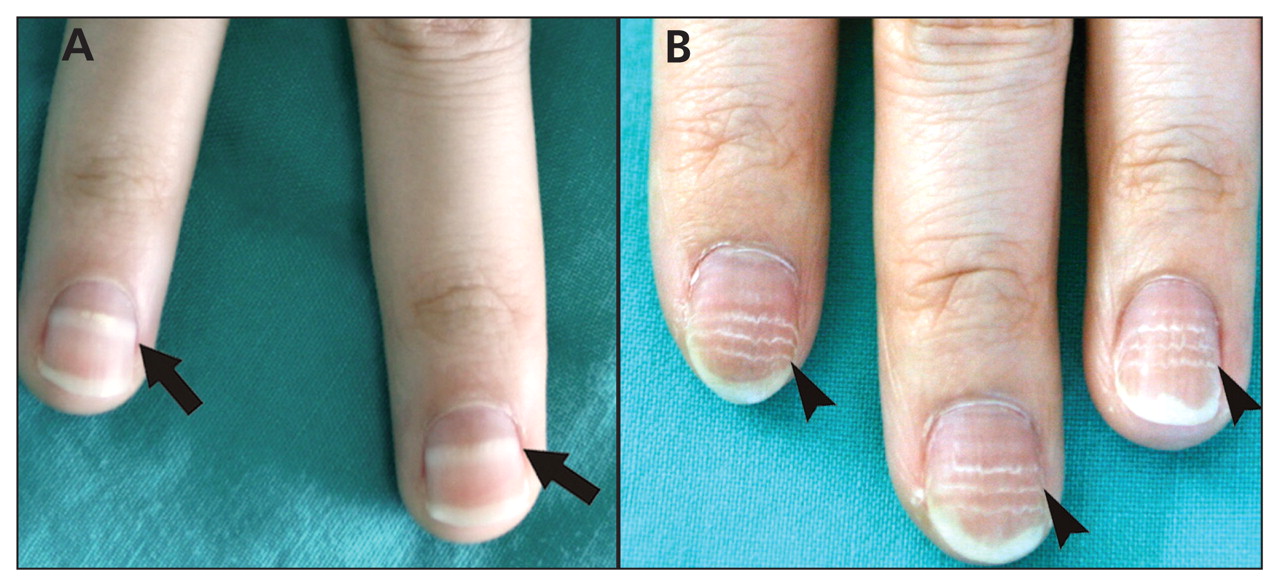 What causes black lines on skin and nails?
