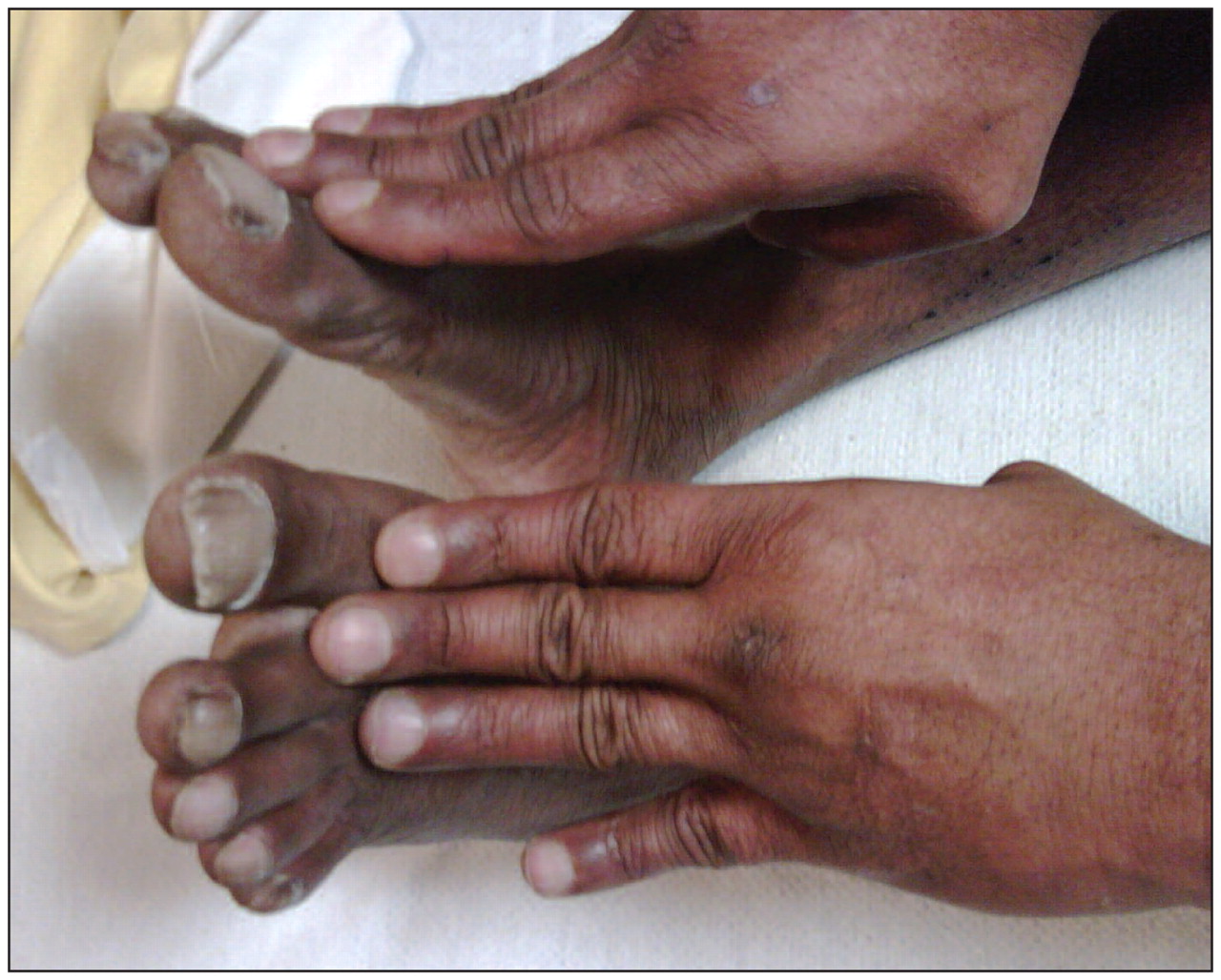 Cyanosis and clubbing in the fingernails. | Download Scientific Diagram