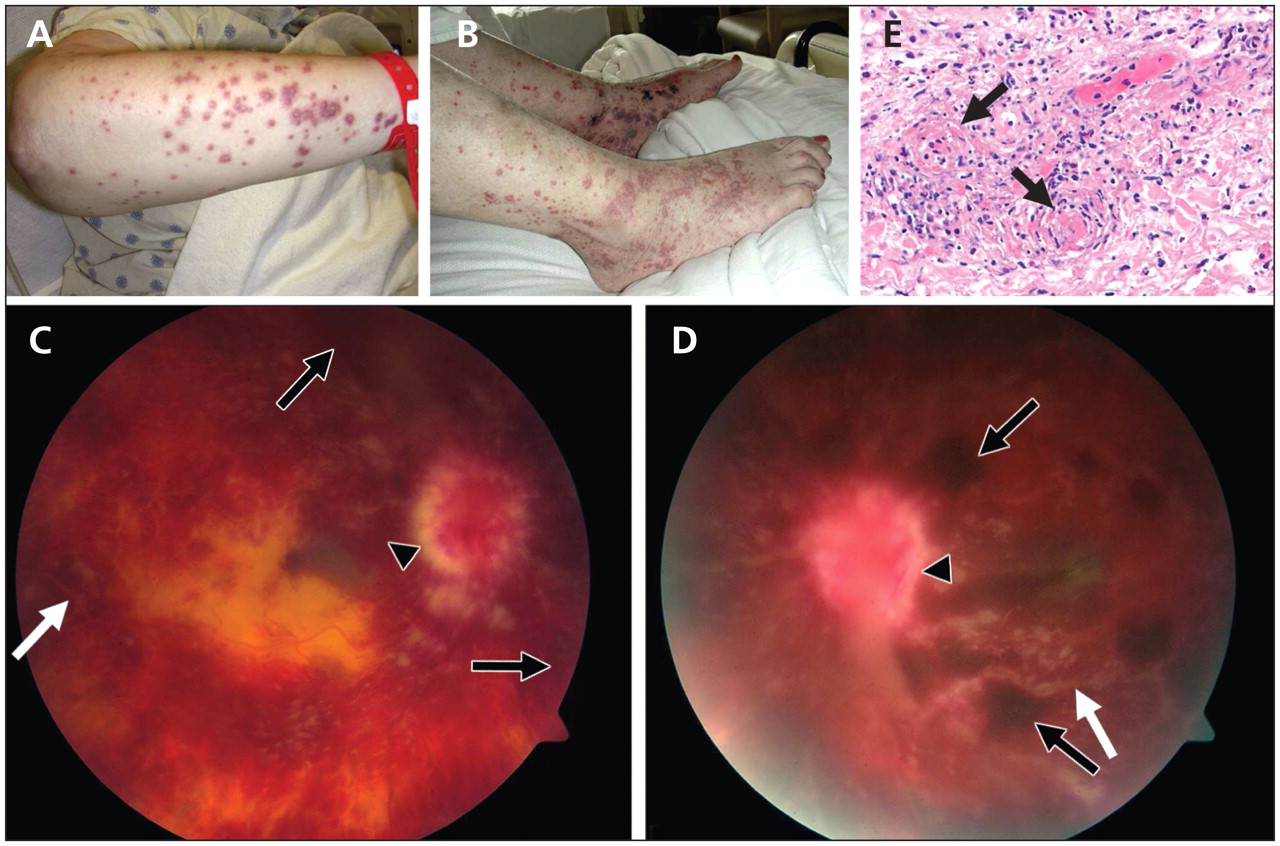 Rash and loss of vision in a 60-year-old woman with systemic lupus