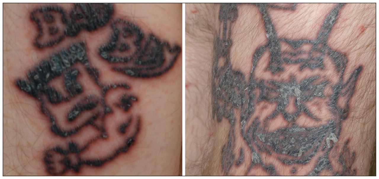 Can you get tattoo with sarcoidosis