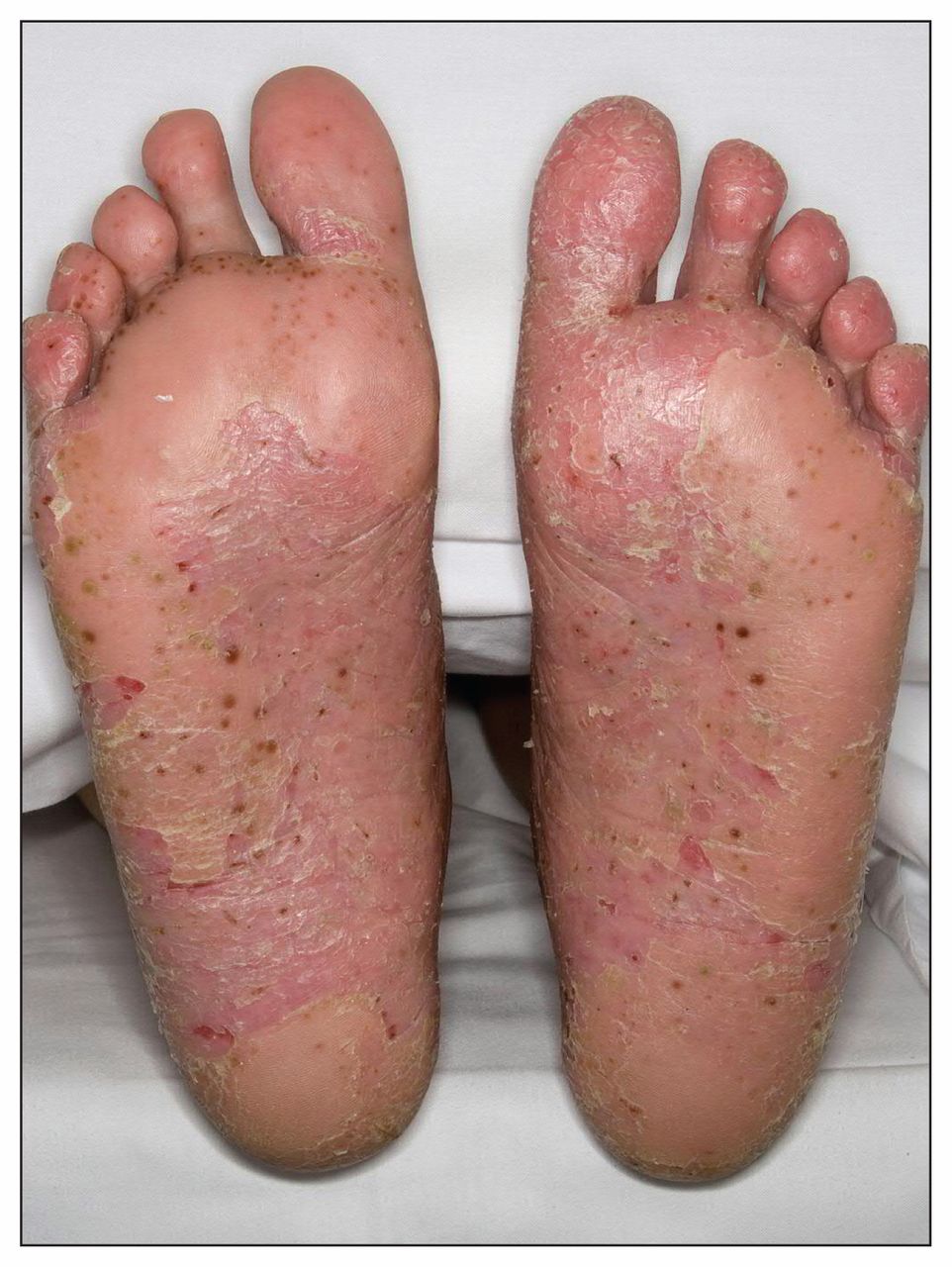 psoriasis pustular feet piros foltok a gyomorban és a hátsó viszketés fotó