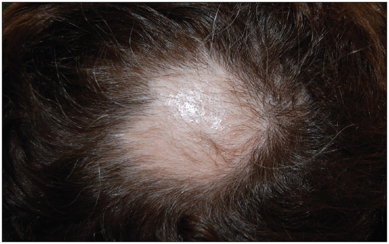 Patchy hair loss in an otherwise healthy man | CMAJ