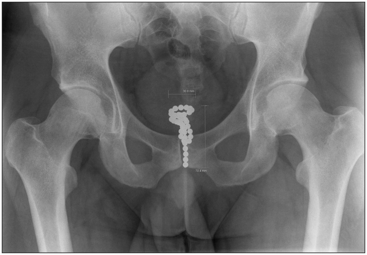 Male urethral insertion