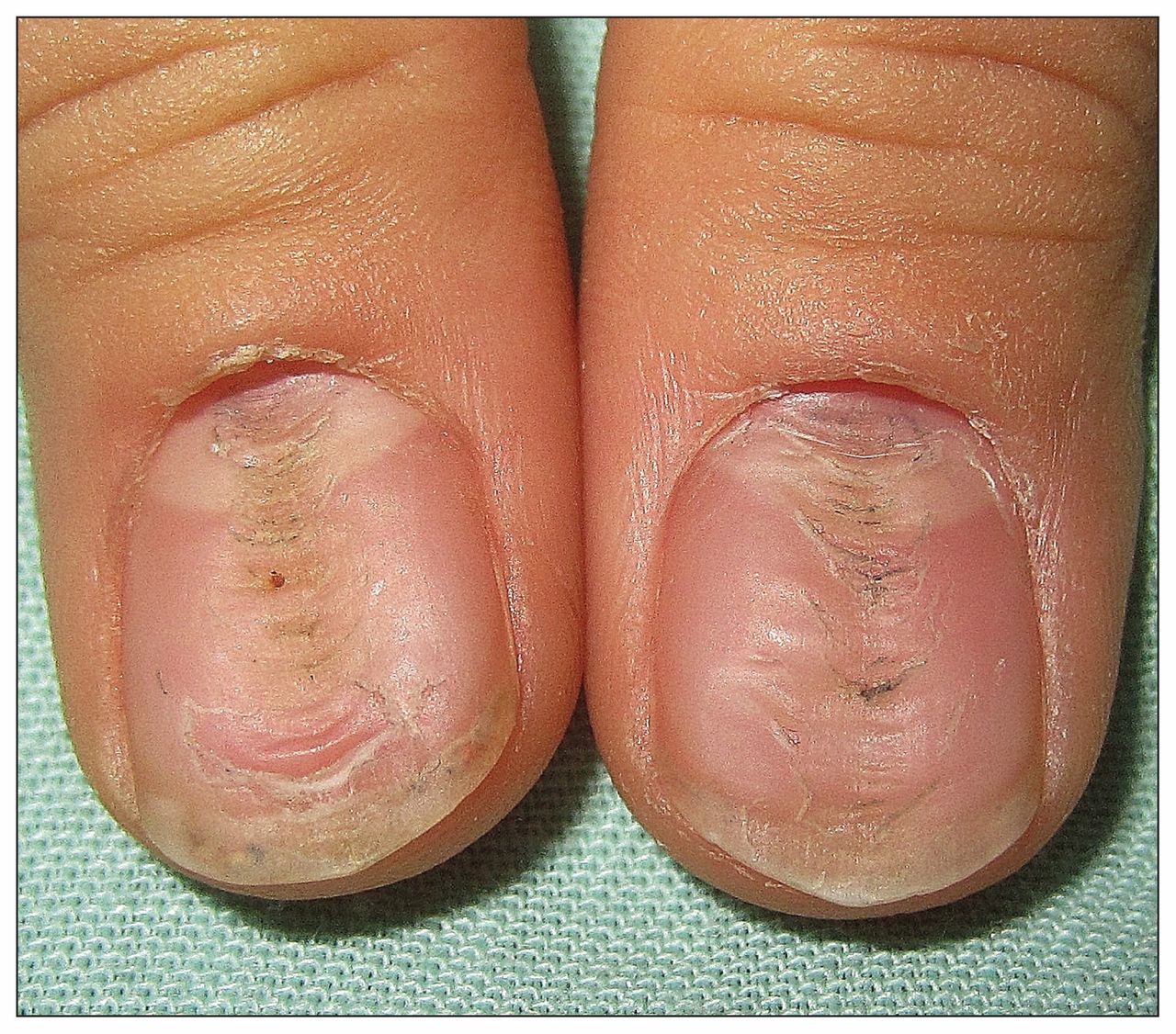 What caused these distal nail changes? | Consultant360
