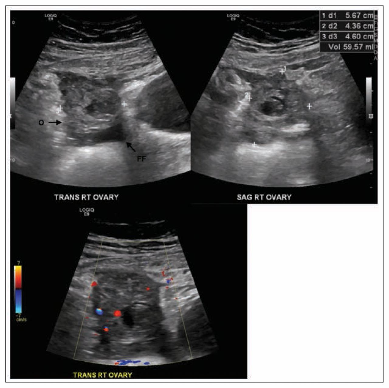 Imaging of ectopic pregnancy - Document - Gale Academic OneFile