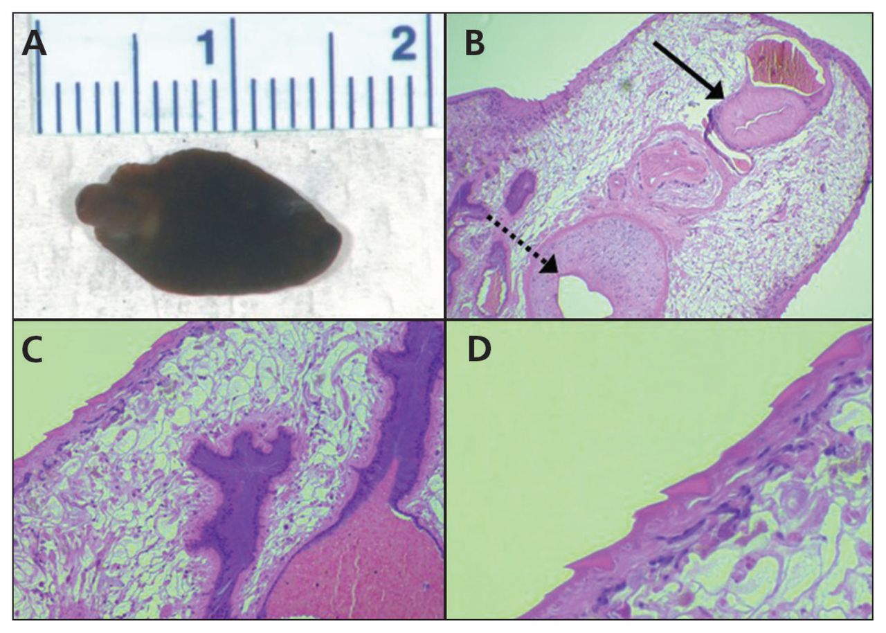 Biliary obstruction caused by the liver fluke, Fasciola hepatica