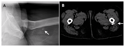 Calcific Tendinitis Of The Gluteus Maximus Of A Year Old Woman Cmaj