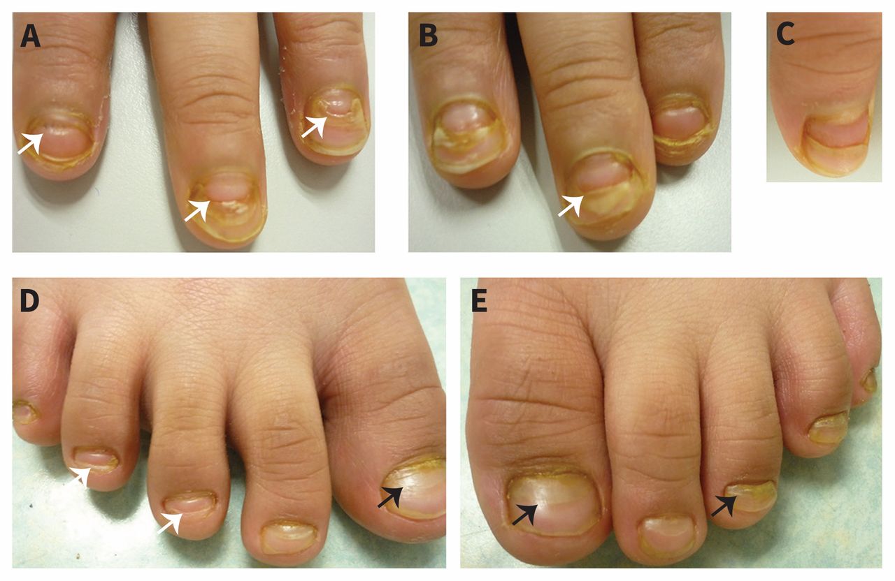 Brown Line on Nails: Vitamin Deficiencies and Other Causes