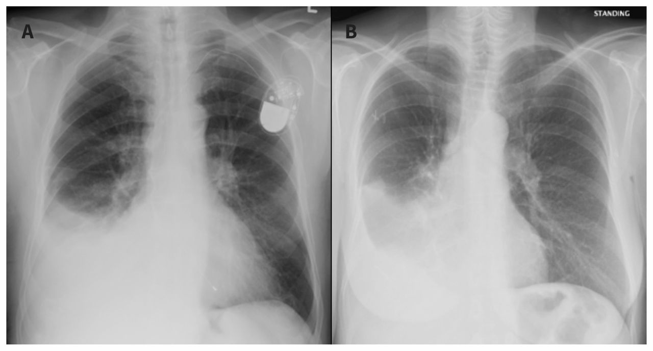 Evaluation Of The Patient With Pleural Effusion Cmaj