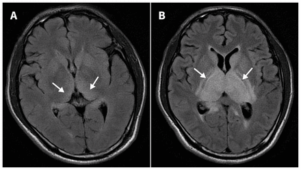 encephalitis otak radang cmaj e657
