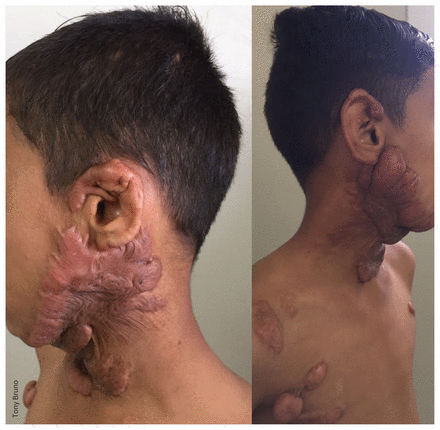 Colour photographs of the neck and chest of a young Kurdish boy, showing scarring.