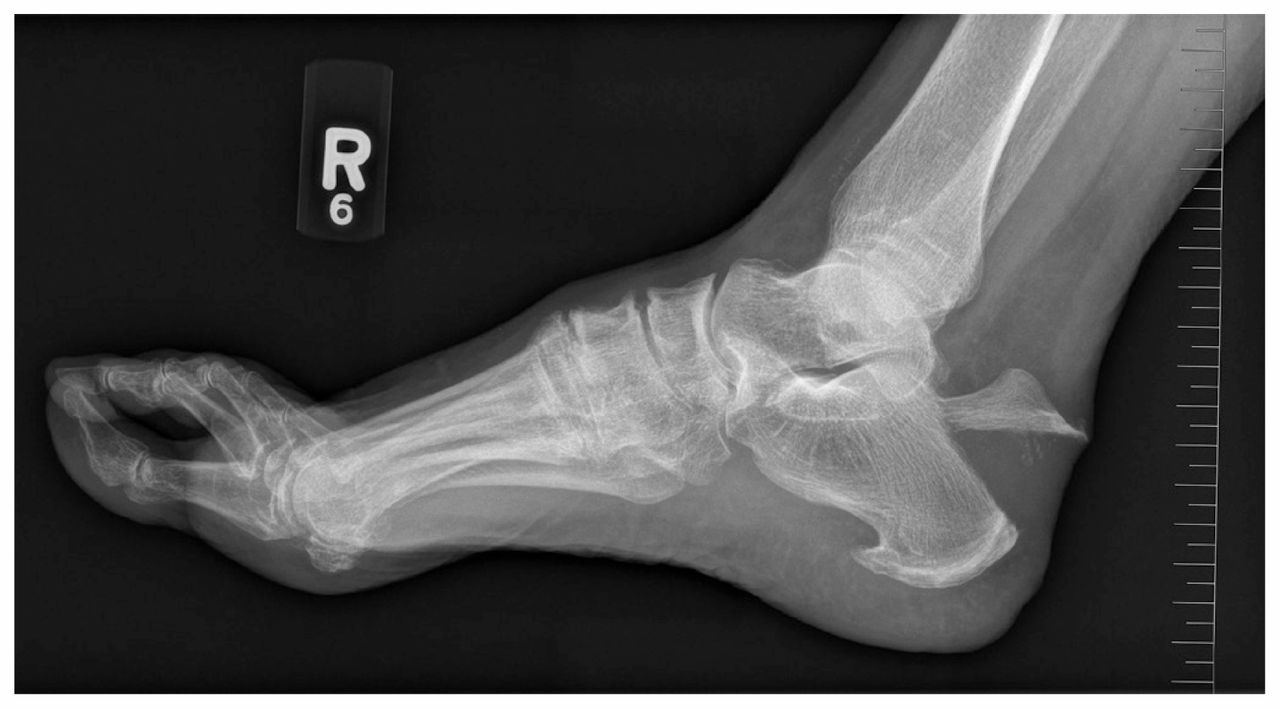 Understanding the Healing Process After an Ankle Fracture:  Arlington/Mansfield Foot & Ankle Centers: Podiatrists