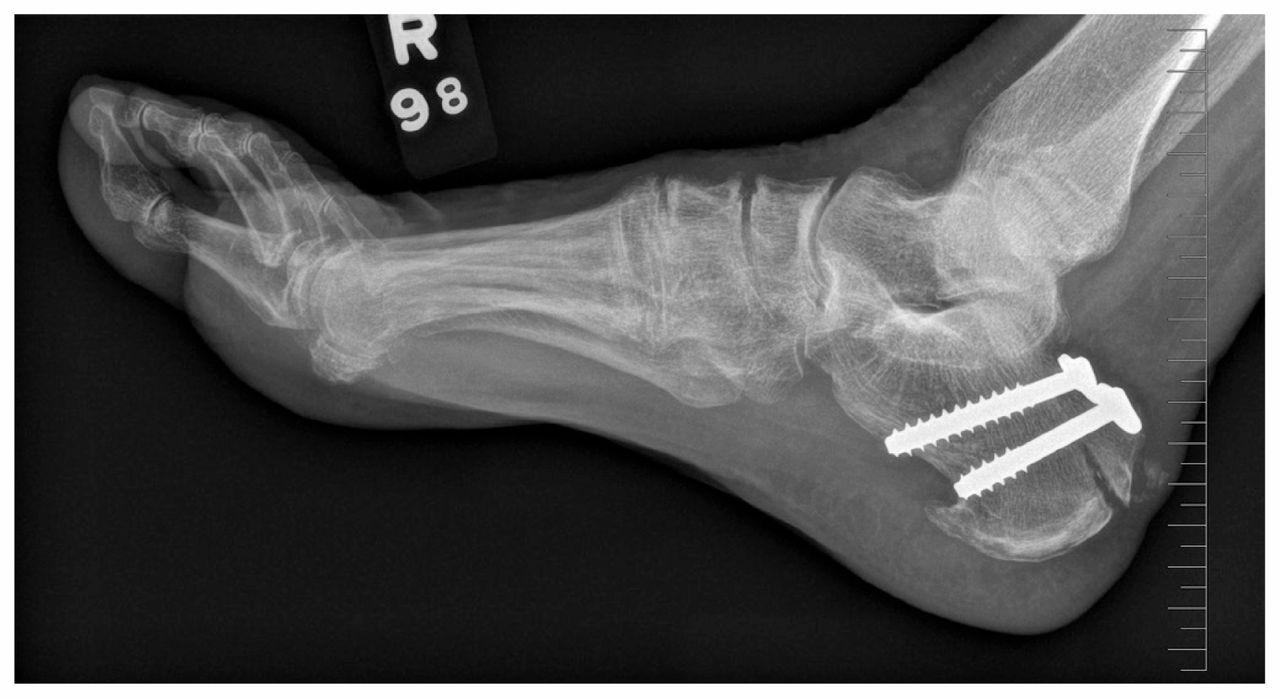 Heel Bone (Calcaneus) Fracture | Boston Medical Center