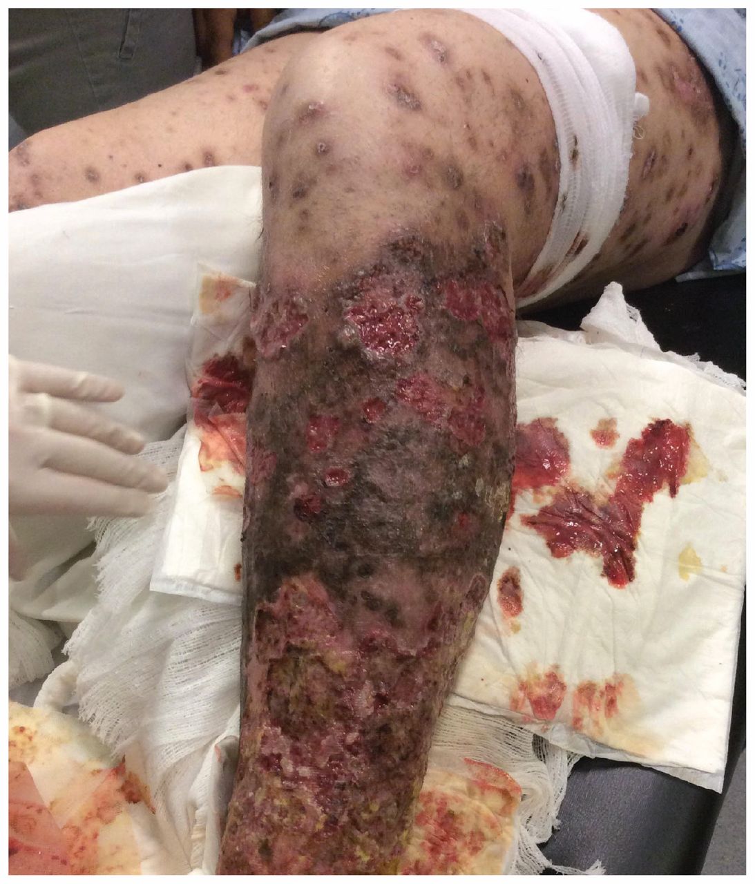 Necrotic leg ulcers associated with krokodil injection in a 41