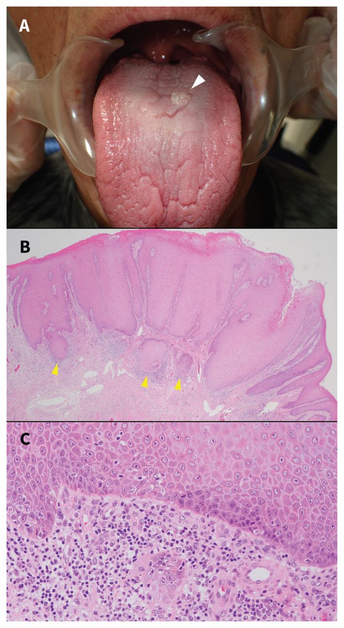 Squamous cell carcinoma of the dorsal tongue | CMAJ