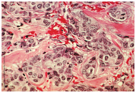 Histological slide photo showing cancererous cells from breast tissues, stained with hematoxylin and eosin and magnified 200x.