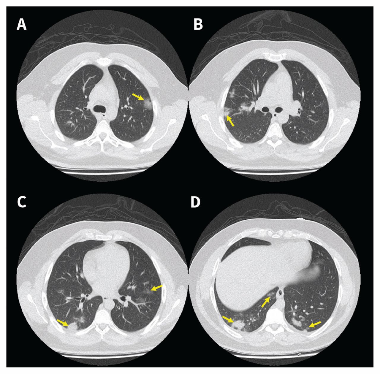 Chest imaging of an early Canadian of COVID-19 in a 28-year-old man | CMAJ