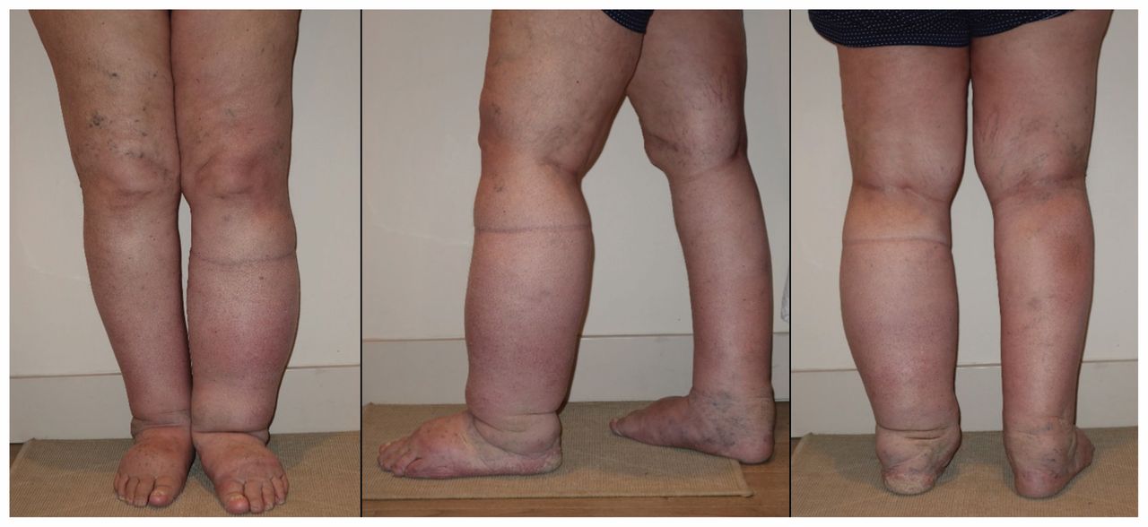 Treatment for Lymphedema - The Lymphedema Association of Manitoba