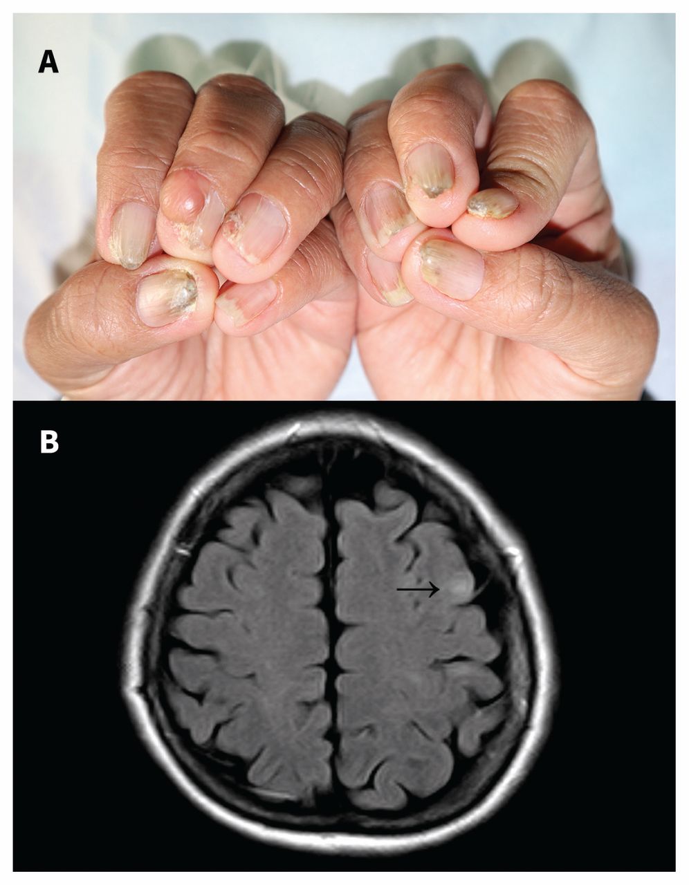 Figure 4 from Clinical and radiological findings related to tuberous  sclerosis complex: a case report. | Semantic Scholar