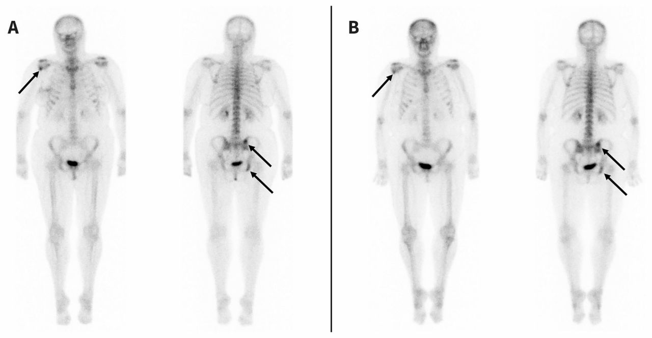 Osseous sarcoidosis mimicking metastatic breast cancer