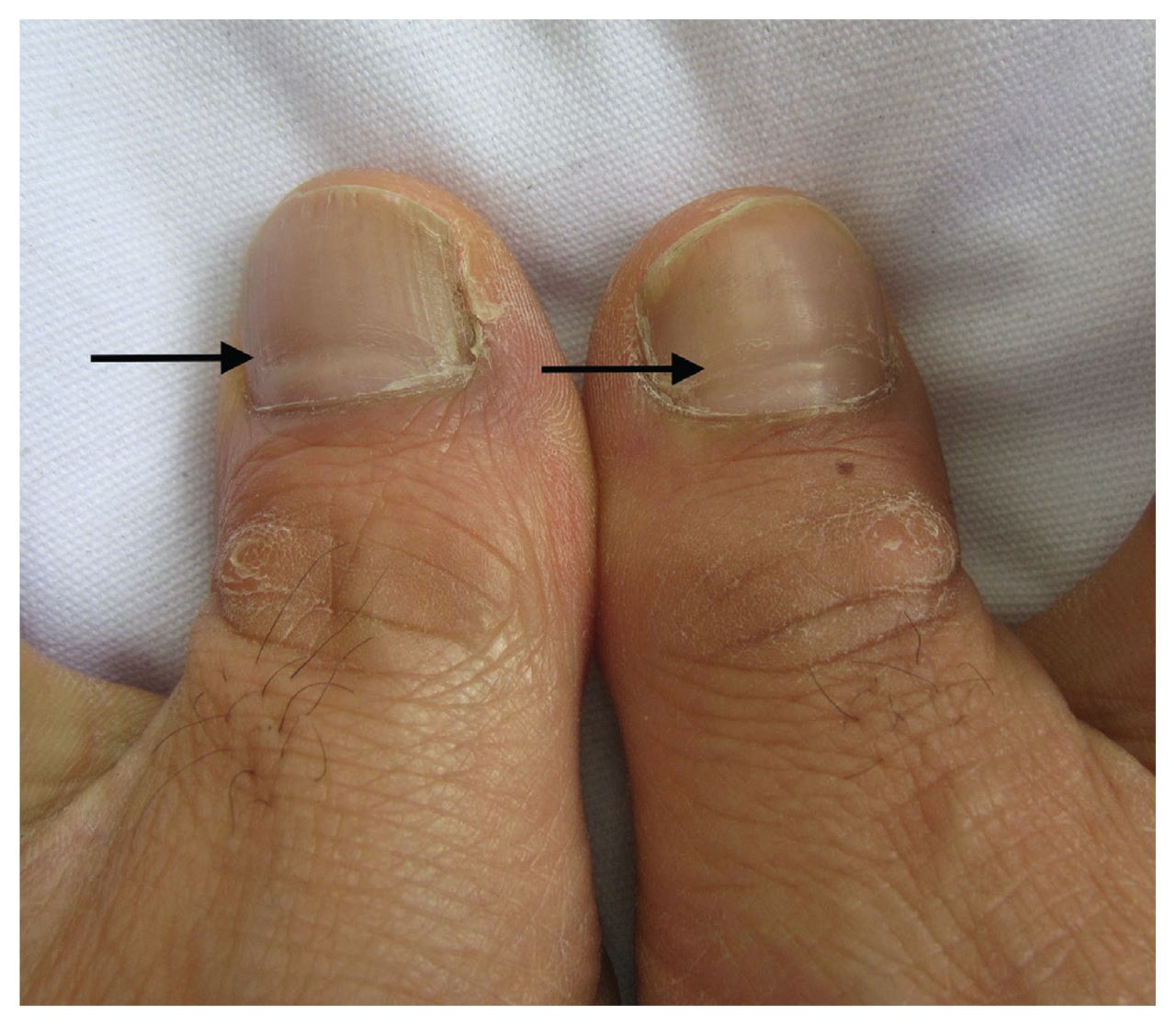 What is a thick white verticalline on my big toe and thumb nail? - Quora