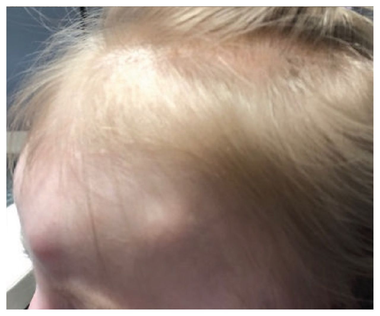Rapidly enlarging scalp nodules in a 20-month-old child | CMAJ
