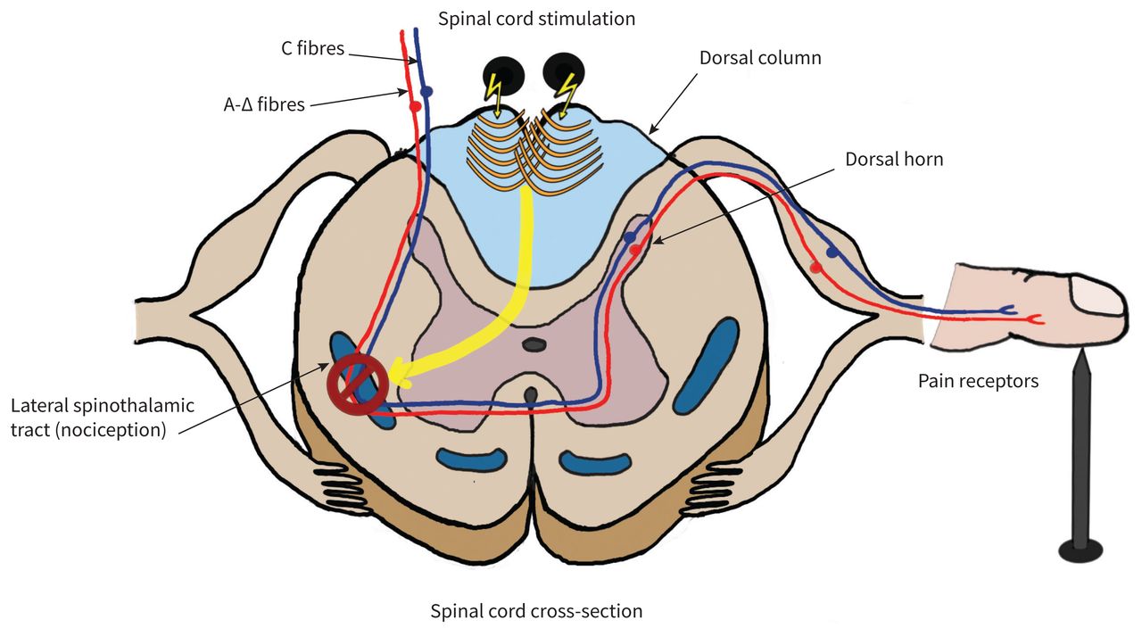 Spinal cord stimulation: a nonopioid alternative for chronic pain