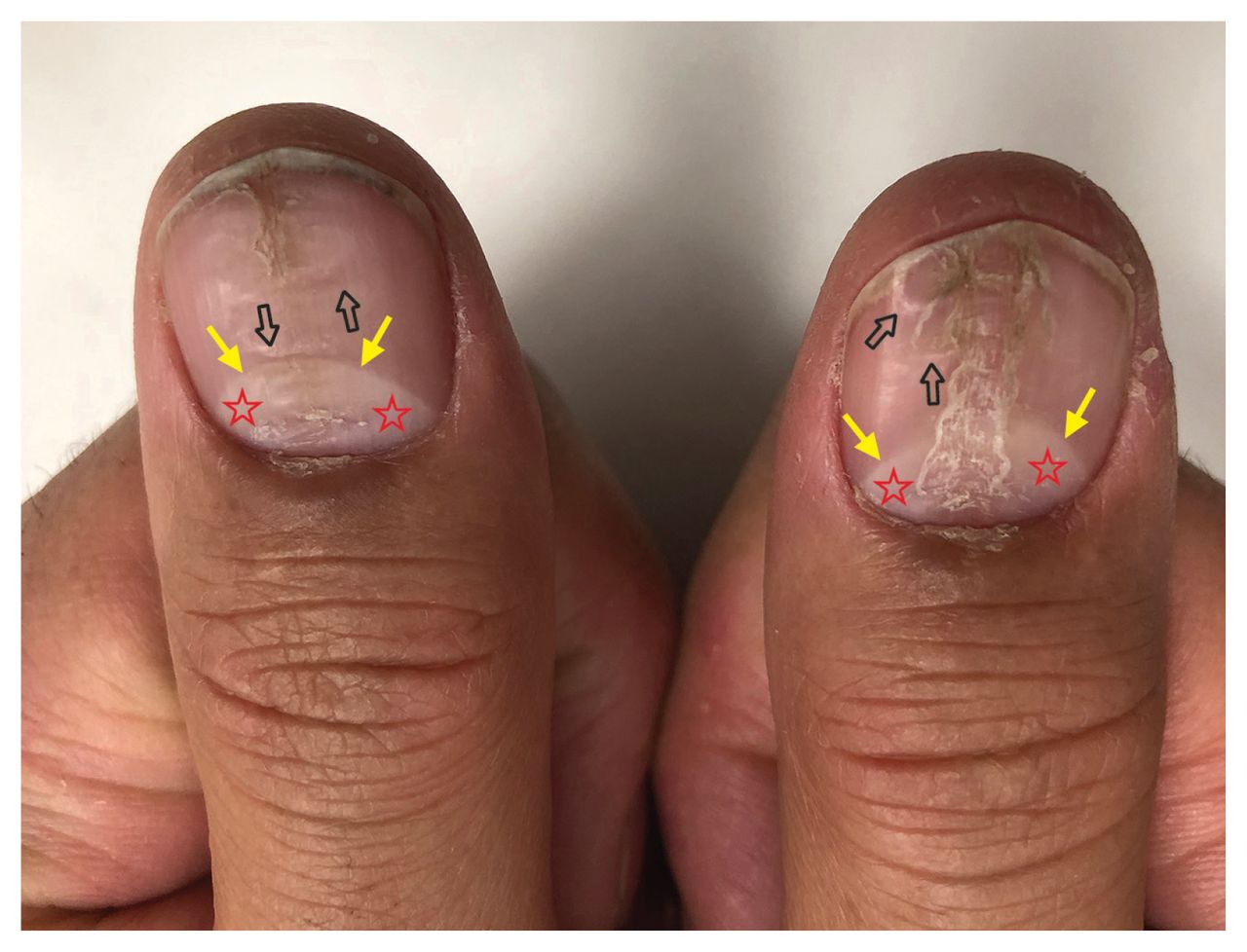 Total melanonychia of 20 nails as a rare manifestation of vitamin B12  deficiency - JAAD Case Reports