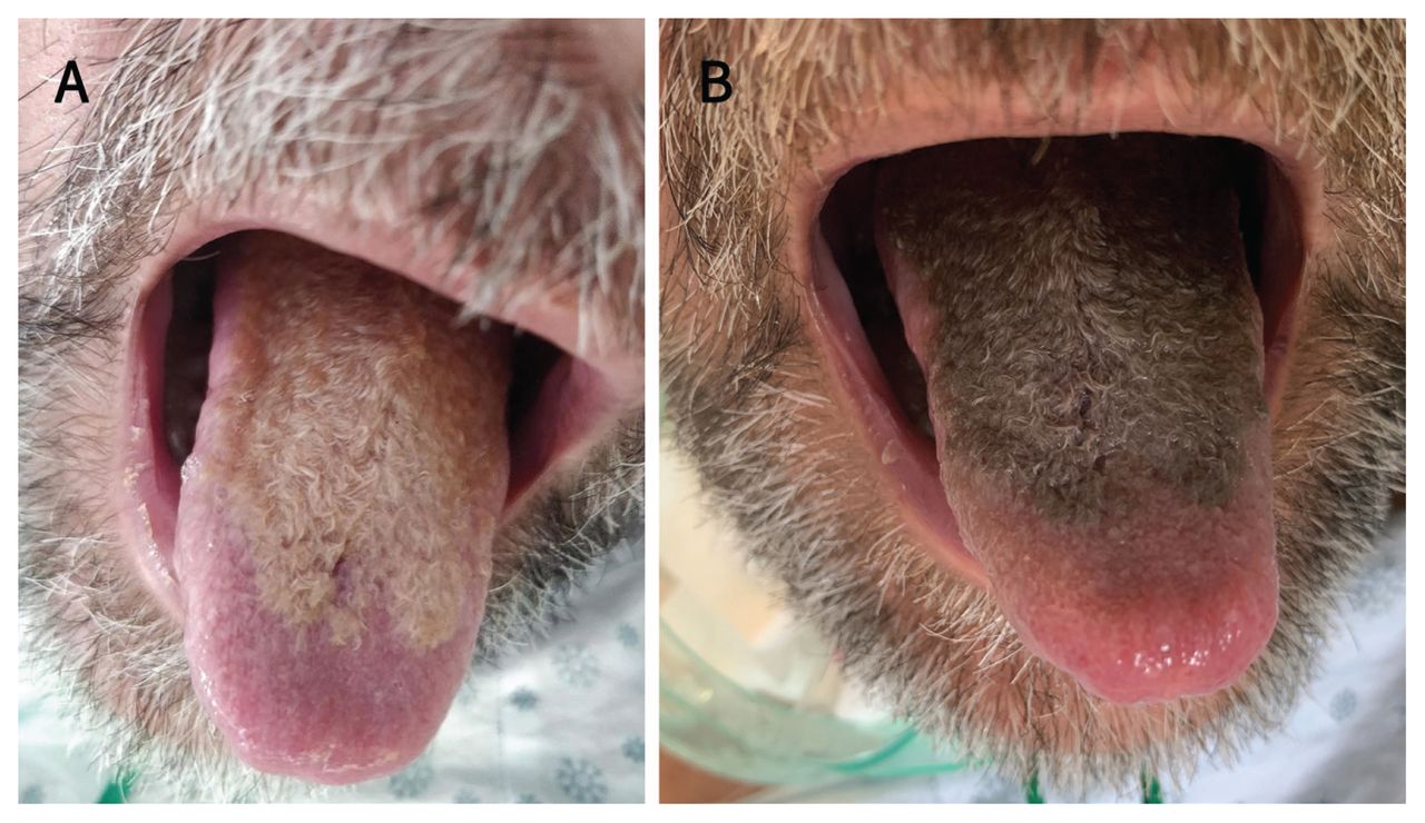 Hairy Tongue Background Pathophysiology Etiology