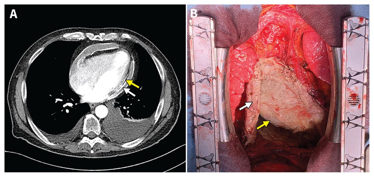 Constrictive pericarditis with pericardial calcification | CMAJ