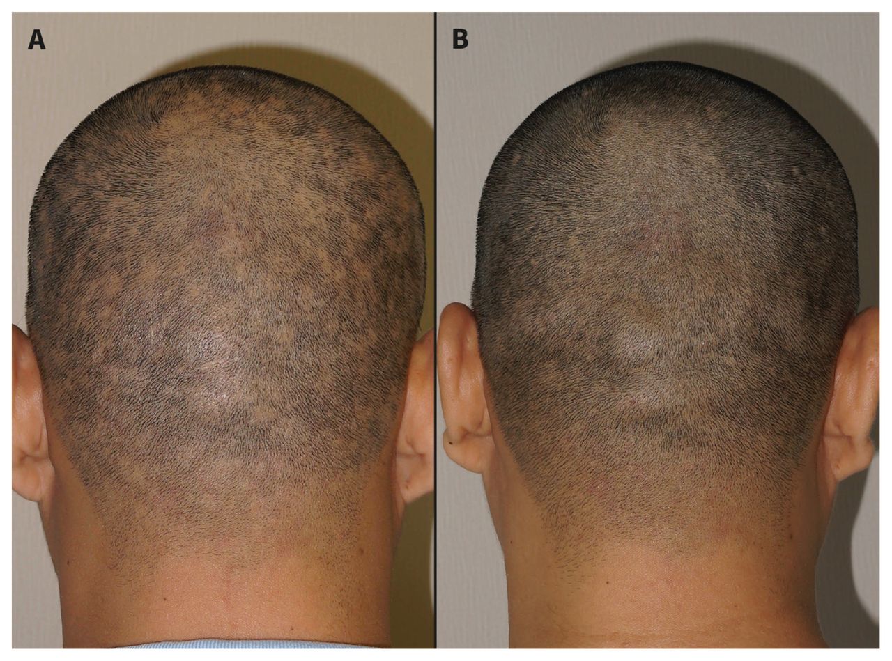 Can Syphilis Make You Lose Your Hair? 