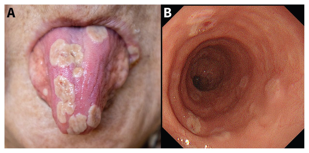 81-year-old woman with (A) herpetic glossitis, appearing as pseudotumoral p...