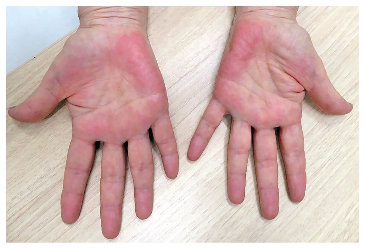 Treatment of Chronic Paronychia: A Double Blind Comparative Clinical Trial  Using Singly Vaseline, Nystatin and Fucidic Acid Ointment