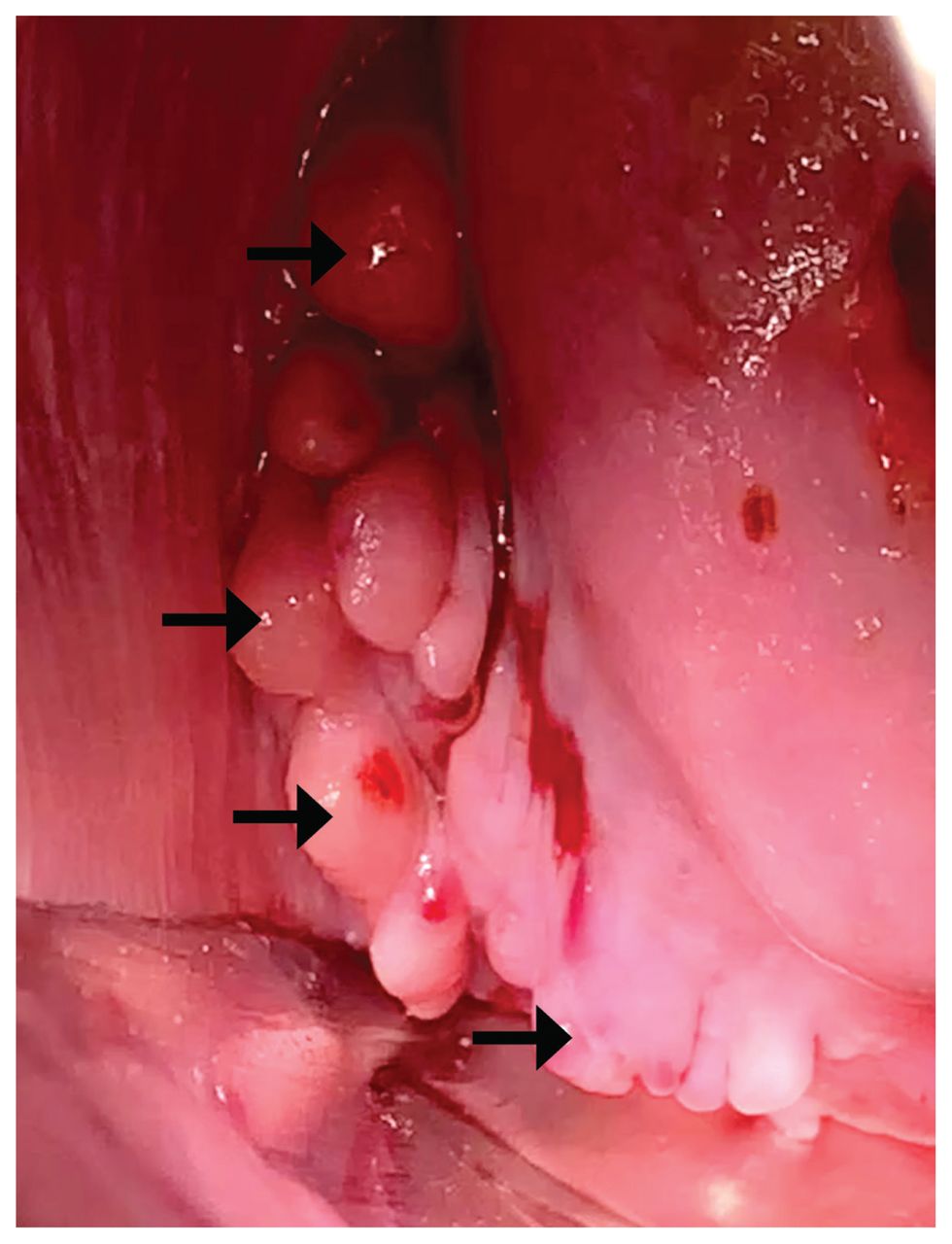Endométriose polypoïde vaginale | CMAJ