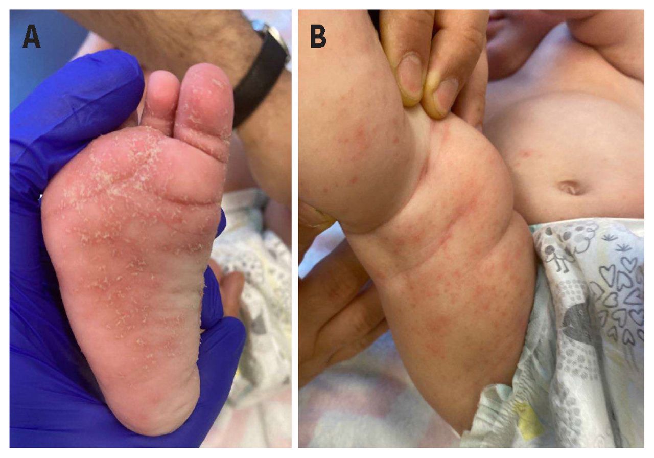 Oral ivermectin treatment for an infant with crusted scabies